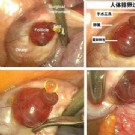 医生首次拍到人类排卵照片