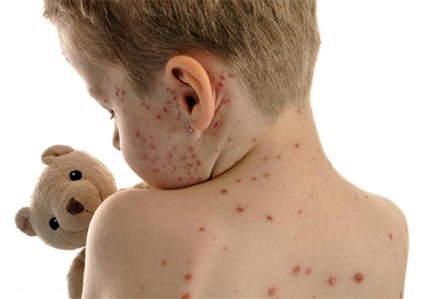 [第633期]春季水痘多发期需警惕
