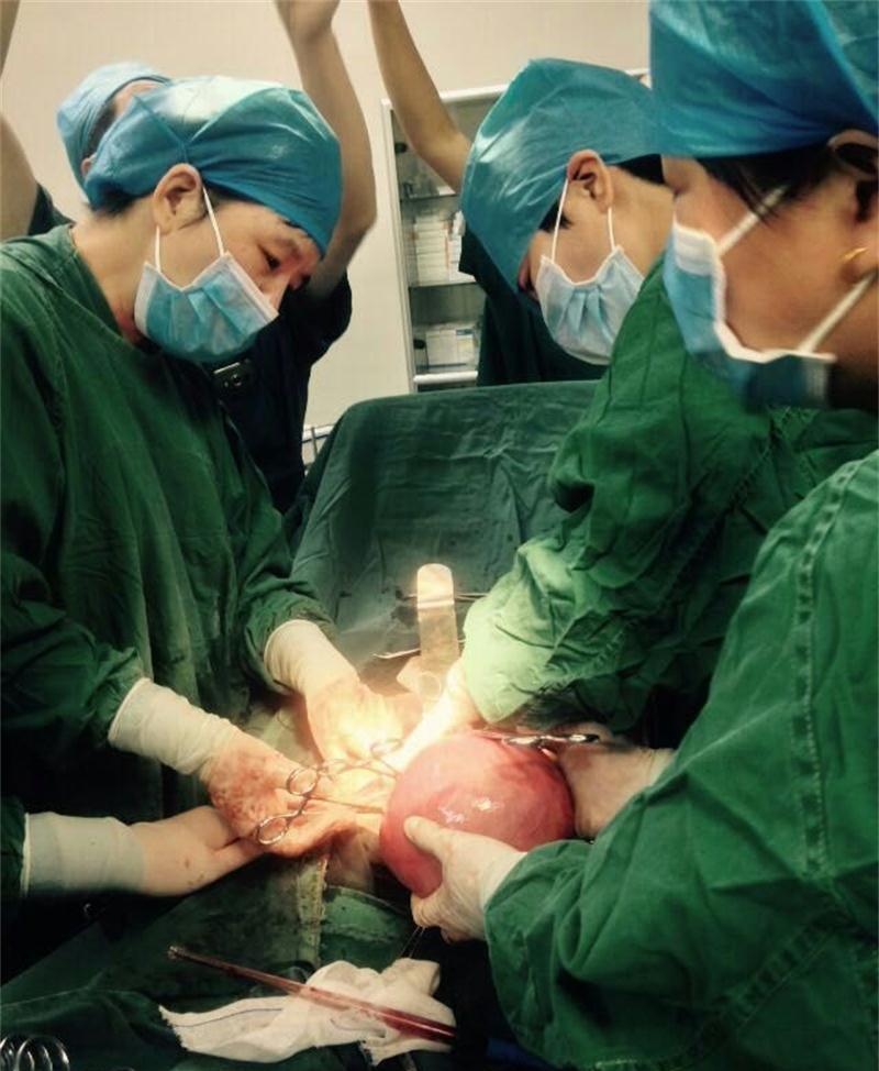 河北省内丘县中医院成功切除一巨大子宫肌瘤
