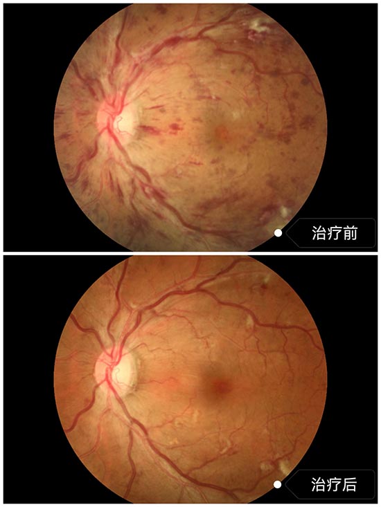 玻璃体腔药物注射+激光治疗视网膜静脉阻塞