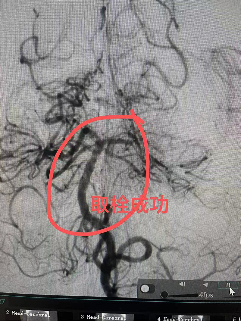 馆陶县中医院再次完成颅内基底动脉取栓手术